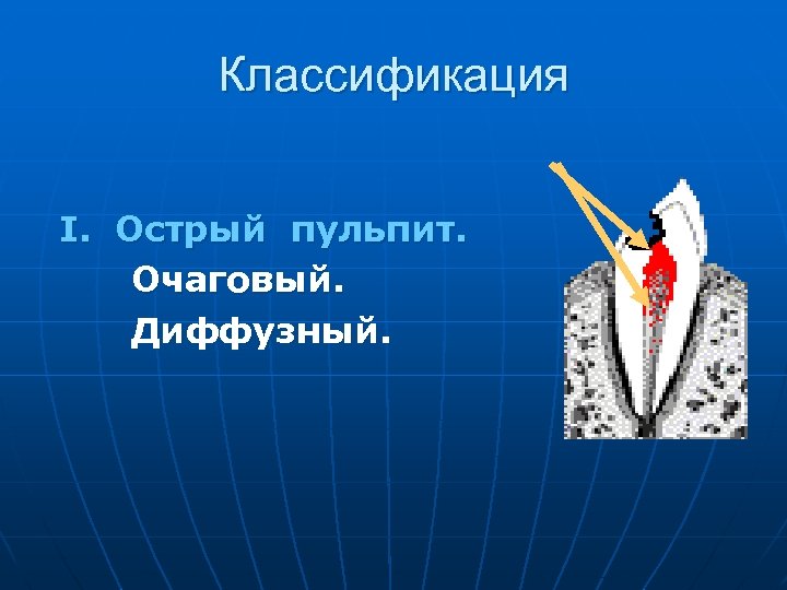 Классификация I. Острый пульпит. Очаговый. Диффузный. 