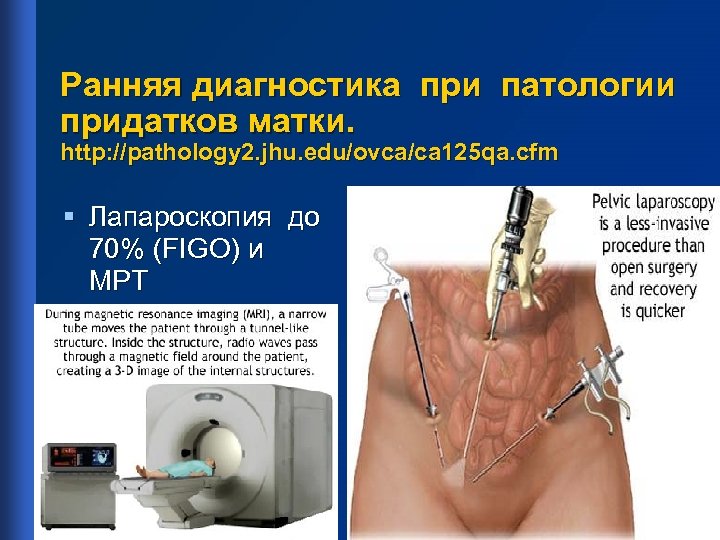 Ранняя диагностика при патологии придатков матки. http: //pathology 2. jhu. edu/ovca/ca 125 qa. cfm