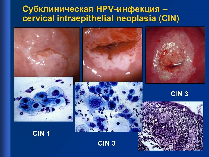 Субклиническая HPV-инфекция – cervical intraepithelial neoplasia (CIN) CIN 3 Photo courtesy of Marion M.