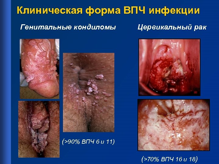 Клиническая форма ВПЧ инфекции Генитальные кондиломы Цервикальный рак (>90% ВПЧ 6 и 11) (>70%