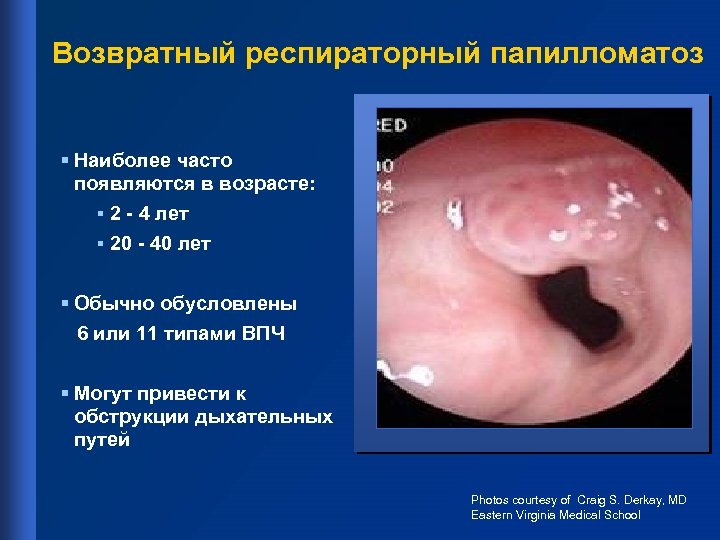 Возвратный респираторный папилломатоз § Наиболее часто появляются в возрасте: § 2 - 4 лет