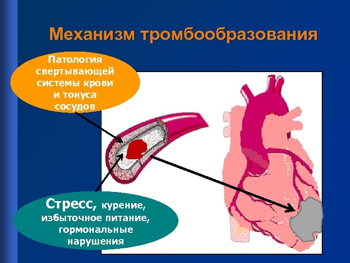 Механизм тромбообразования Патология свертывающей системы крови и тонуса сосудов Стресс, курение, избыточное питание, гормональные