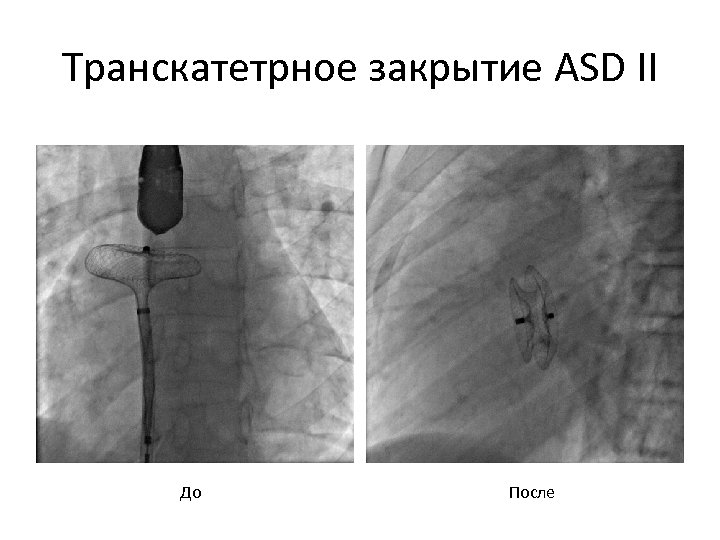 Транскатетрное закрытие ASD II До После 