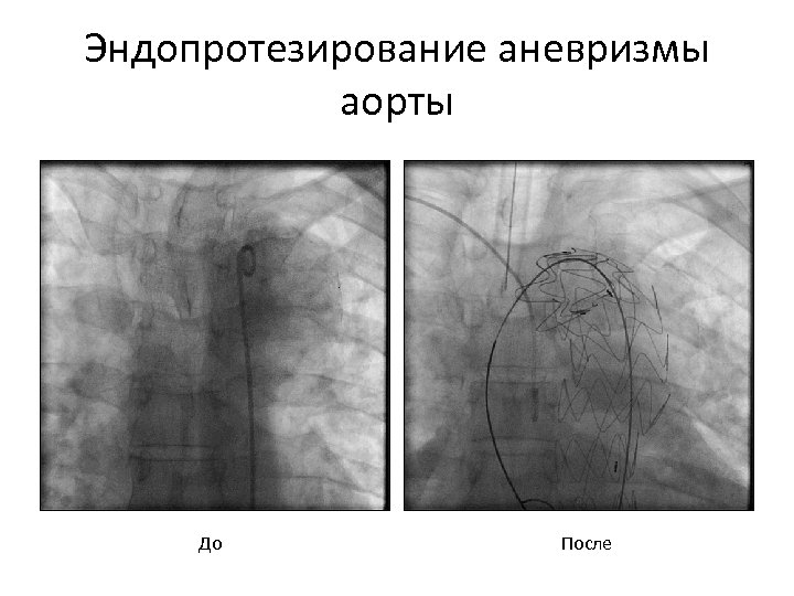 Эндопротезирование аневризмы аорты До После 