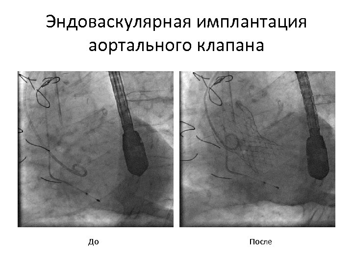 Эндоваскулярная имплантация аортального клапана До После 