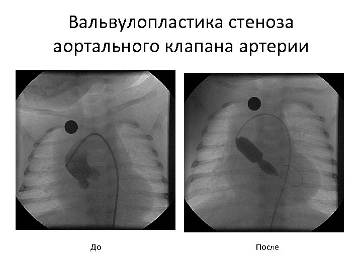 Вальвулопластика стеноза аортального клапана артерии До После 