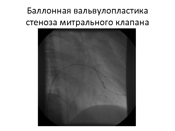 Баллонная вальвулопластика стеноза митрального клапана 