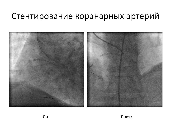 Стентирование коранарных артерий До После 