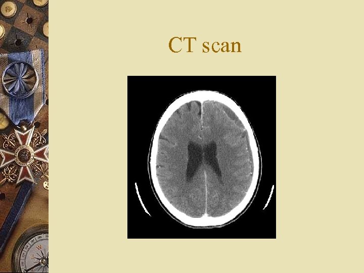 CT scan 