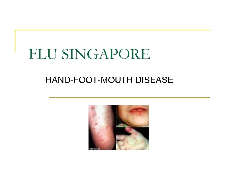 FLU SINGAPORE HAND-FOOT-MOUTH DISEASE 