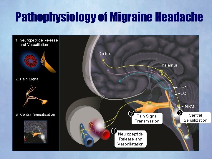 Pathophysiology of Migraine Headache 1. Neuropeptide Release and Vasodilation Cortex Thalamus 2. Pain Signal