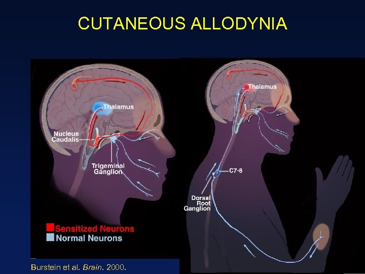 CUTANEOUS ALLODYNIA Burstein et al. Brain. 2000. 34 