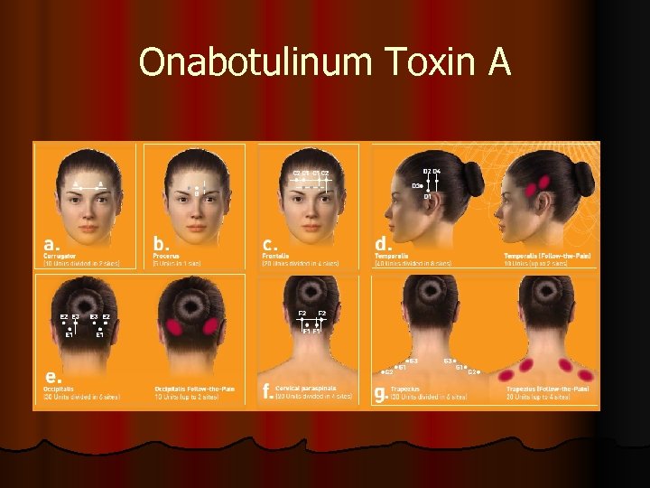 Onabotulinum Toxin A 