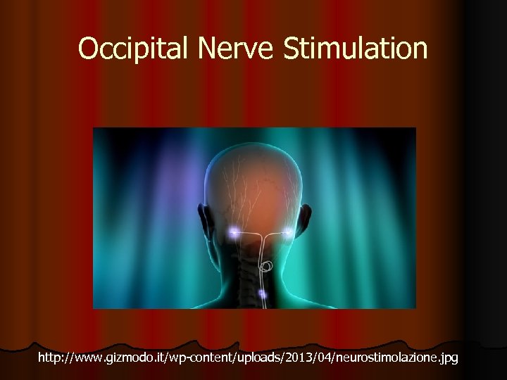 Occipital Nerve Stimulation http: //www. gizmodo. it/wp-content/uploads/2013/04/neurostimolazione. jpg 