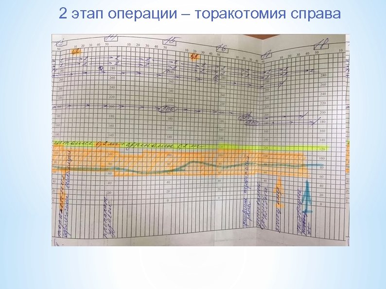 2 этап операции – торакотомия справа 