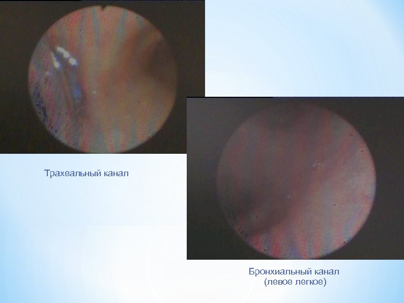 Трахеальный канал Бронхиальный канал (левое легкое) 
