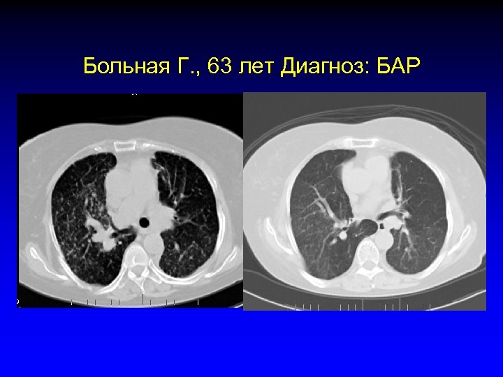 Больная Г. , 63 лет Диагноз: БАР 