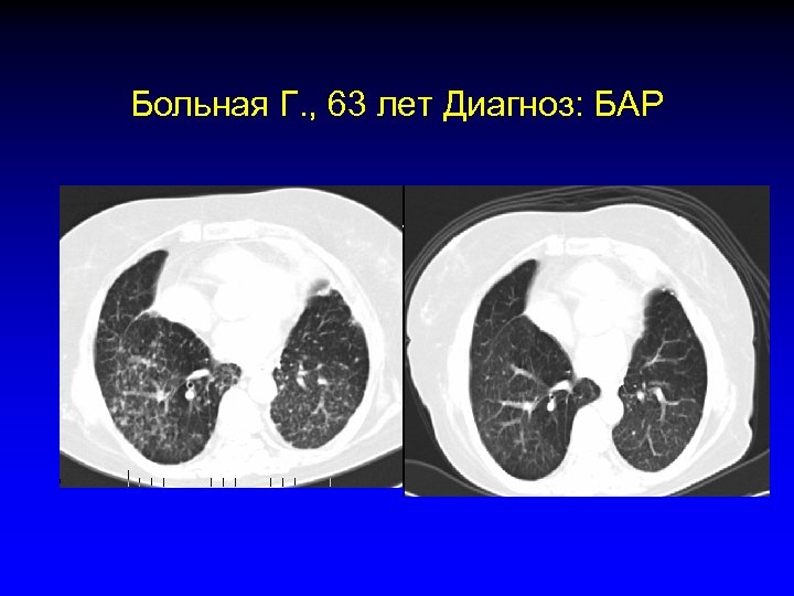 Больная Г. , 63 лет Диагноз: БАР 