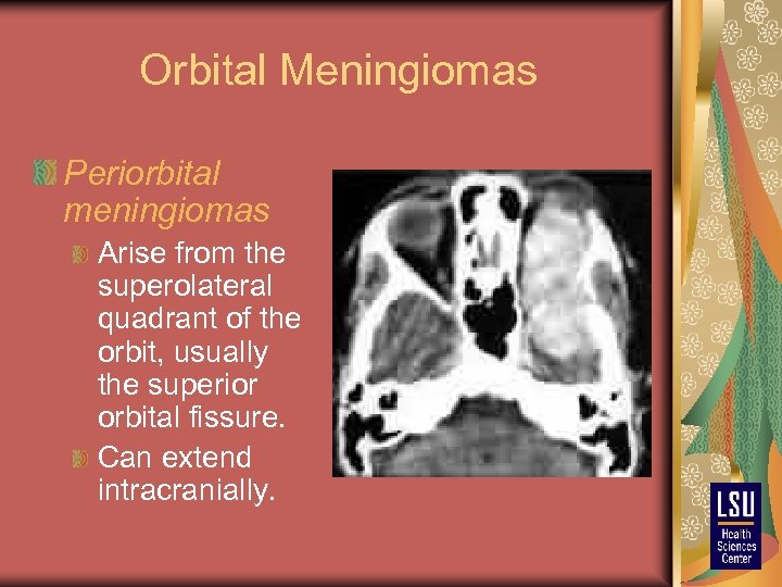 Orbital Meningiomas Periorbital meningiomas Arise from the superolateral quadrant of the orbit, usually the