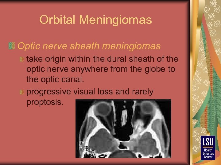 Orbital Meningiomas Optic nerve sheath meningiomas take origin within the dural sheath of the