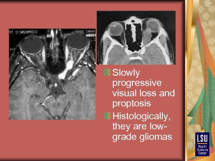 Slowly progressive visual loss and proptosis Histologically, they are lowgrade gliomas 