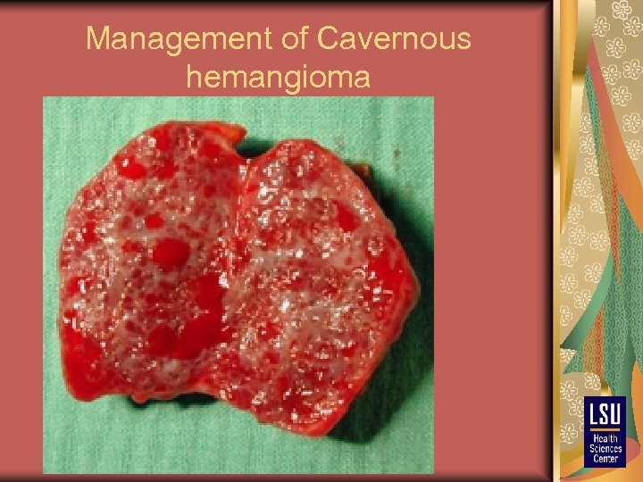 Management of Cavernous hemangioma 