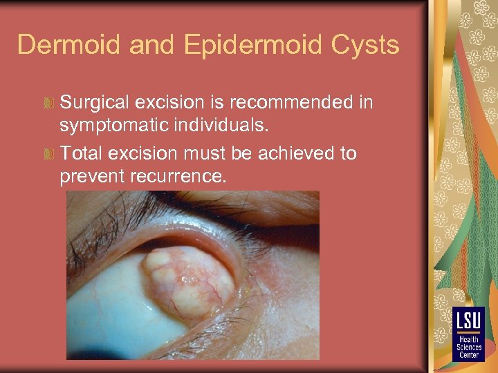 Dermoid and Epidermoid Cysts Surgical excision is recommended in symptomatic individuals. Total excision must