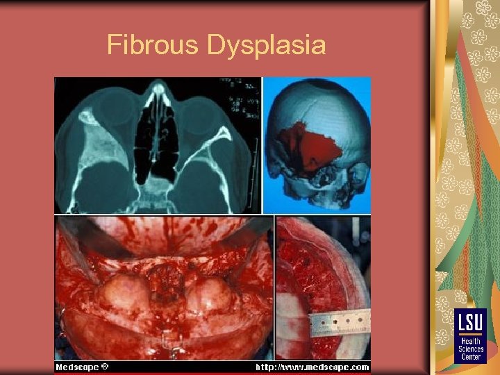 Fibrous Dysplasia 