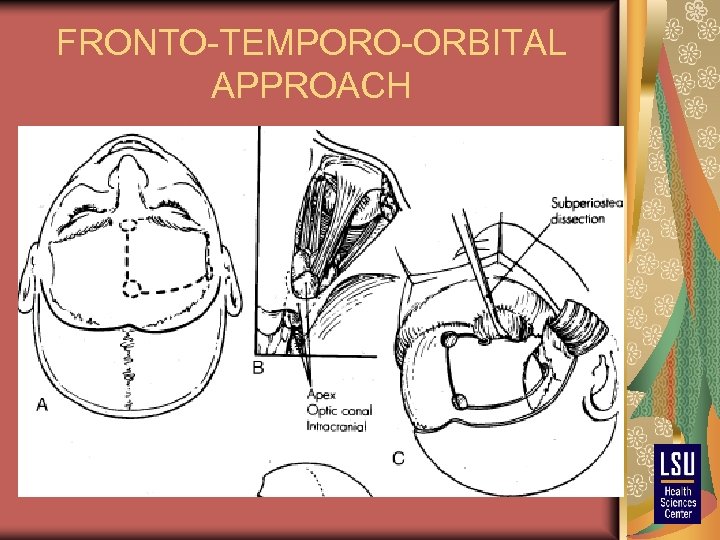 FRONTO-TEMPORO-ORBITAL APPROACH 