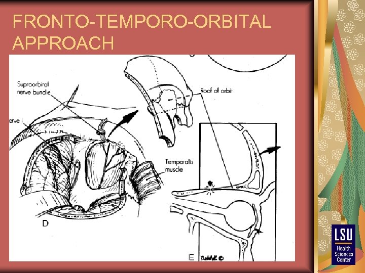 FRONTO-TEMPORO-ORBITAL APPROACH 