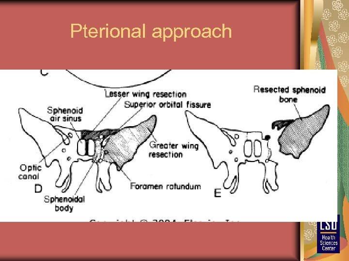 Pterional approach 