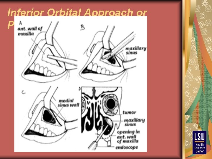 Inferior Orbital Approach or Posteroinferior Orbitotomy 