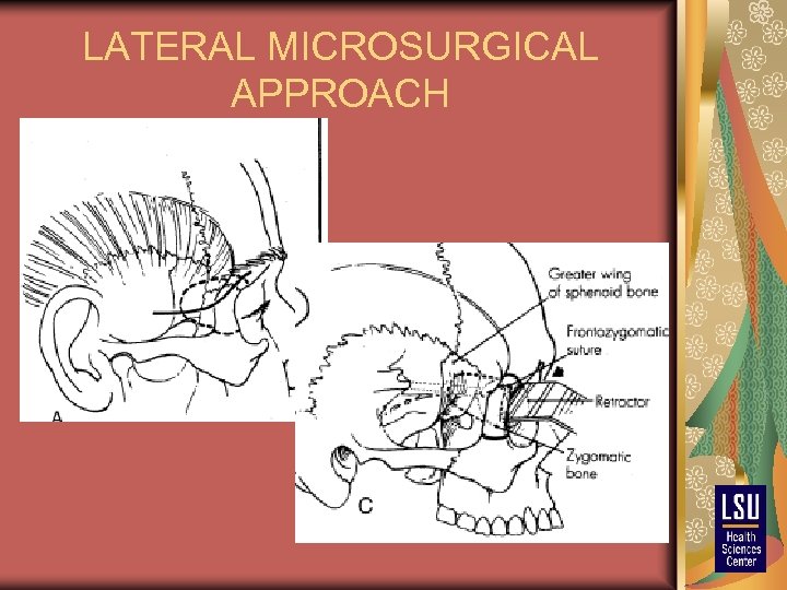 LATERAL MICROSURGICAL APPROACH 