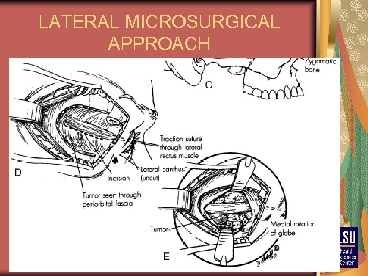 LATERAL MICROSURGICAL APPROACH 