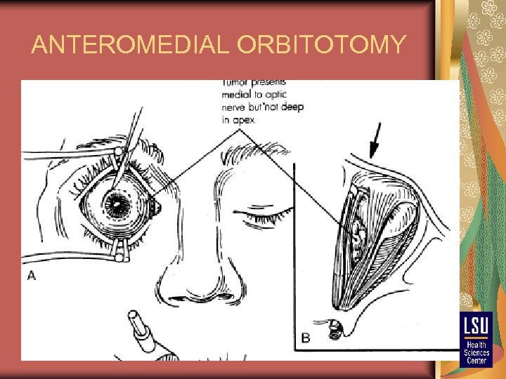 ANTEROMEDIAL ORBITOTOMY 