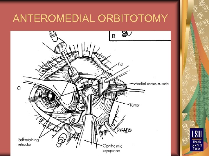 ANTEROMEDIAL ORBITOTOMY 