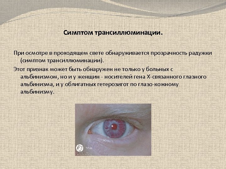 Симптом трансиллюминации. При осмотре в проходящем свете обнаруживается прозрачность радужки (симптом трансиллюминации). Этот признак
