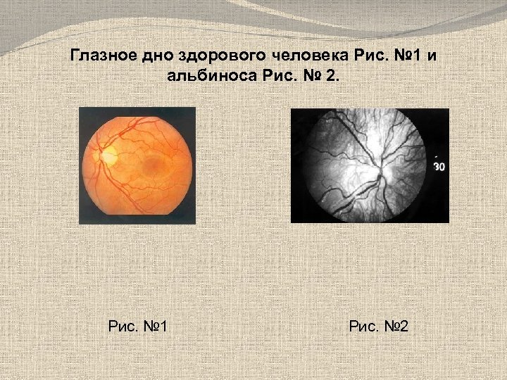 Глазное дно здорового человека Рис. № 1 и альбиноса Рис. № 2. Рис. №