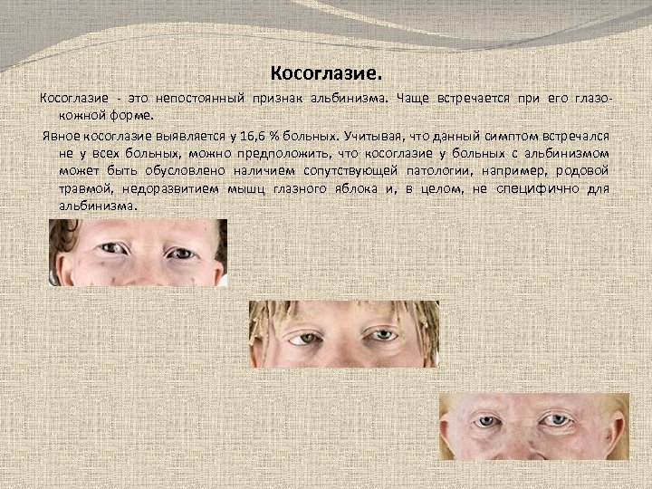 Косоглазие - это непостоянный признак альбинизма. Чаще встречается при его глазокожной форме. Явное косоглазие