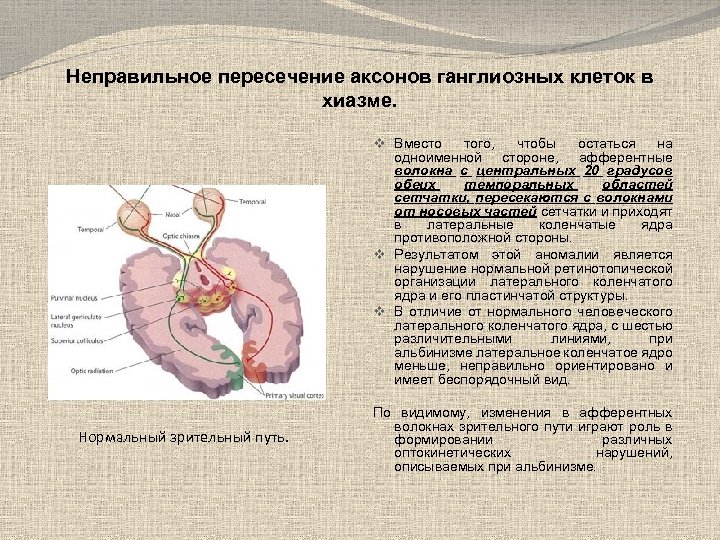 Неправильное пересечение аксонов ганглиозных клеток в хиазме. v Вместо того, чтобы остаться на одноименной