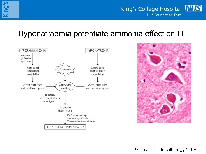 Hyponatraemia potentiate ammonia effect on HE Gines et al Hepathology 2008 