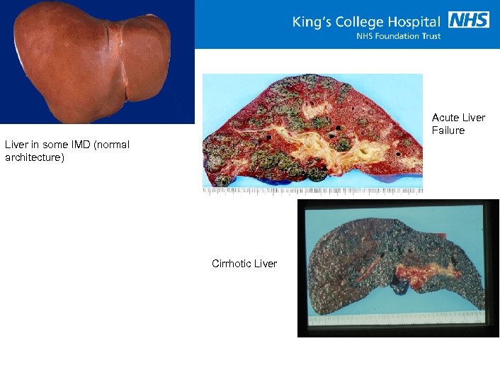 Acute Liver Failure Liver in some IMD (normal architecture) Cirrhotic Liver 