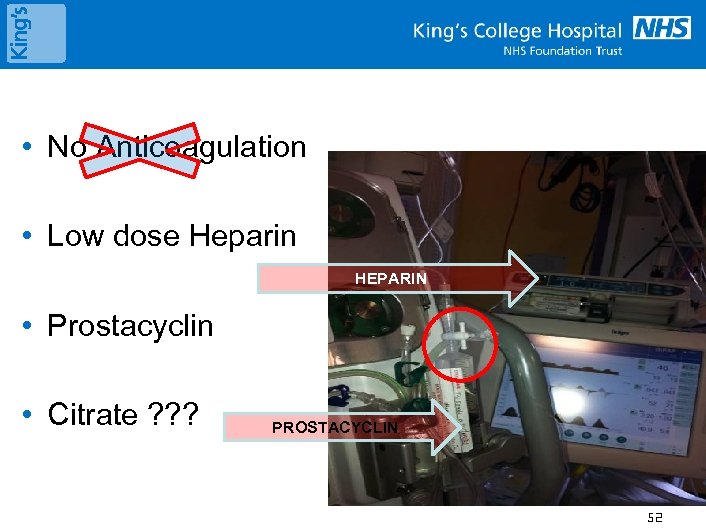  • No Anticoagulation • Low dose Heparin HEPARIN • Prostacyclin • Citrate ?