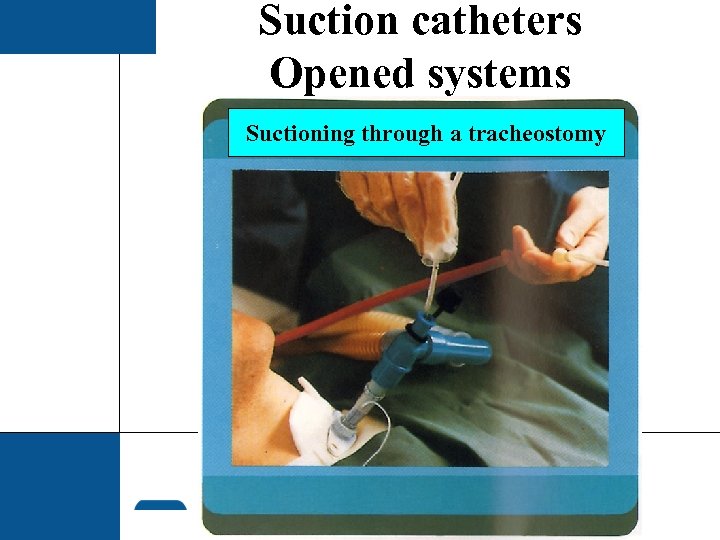 Suction catheters Opened systems Suctioning through a tracheostomy 