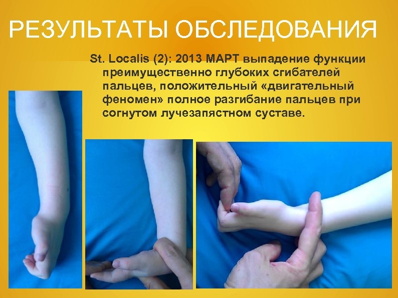 РЕЗУЛЬТАТЫ ОБСЛЕДОВАНИЯ St. Localis (2): 2013 МАРТ выпадение функции преимущественно глубоких сгибателей пальцев, положительный