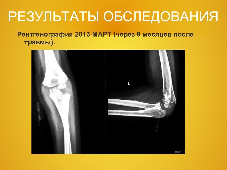 РЕЗУЛЬТАТЫ ОБСЛЕДОВАНИЯ Рентгенография 2013 МАРТ (через 8 месяцев после травмы). 