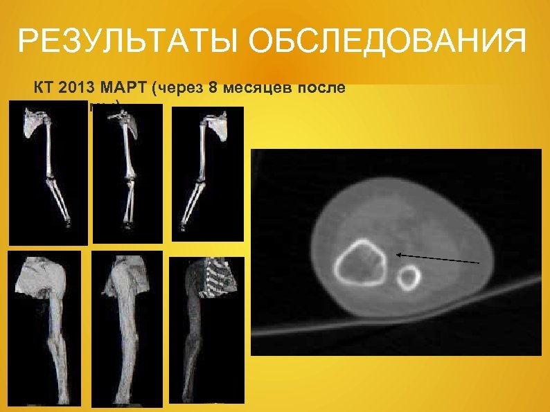 РЕЗУЛЬТАТЫ ОБСЛЕДОВАНИЯ КТ 2013 МАРТ (через 8 месяцев после травмы). 