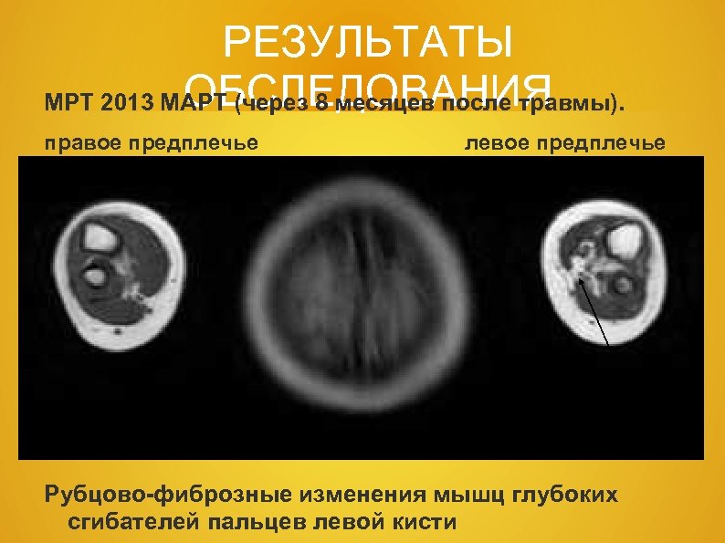 РЕЗУЛЬТАТЫ ОБСЛЕДОВАНИЯ МРТ 2013 МАРТ (через 8 месяцев после травмы). правое предплечье левое предплечье