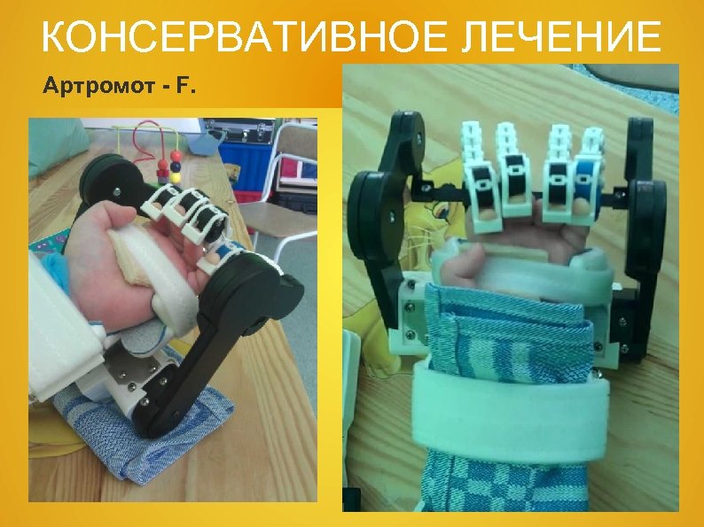 КОНСЕРВАТИВНОЕ ЛЕЧЕНИЕ Артромот - F. 