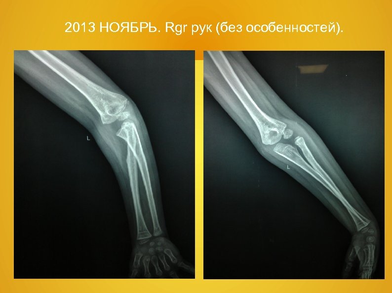 2013 НОЯБРЬ. Rgr рук (без особенностей). 